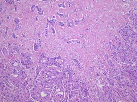 Pathology Outlines Salivary Duct Carcinoma