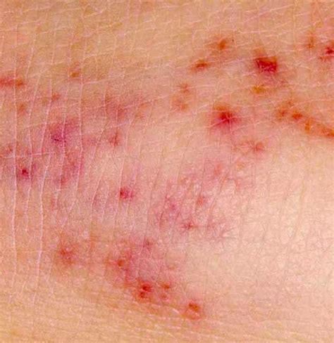 Identifying Skin Rashes In