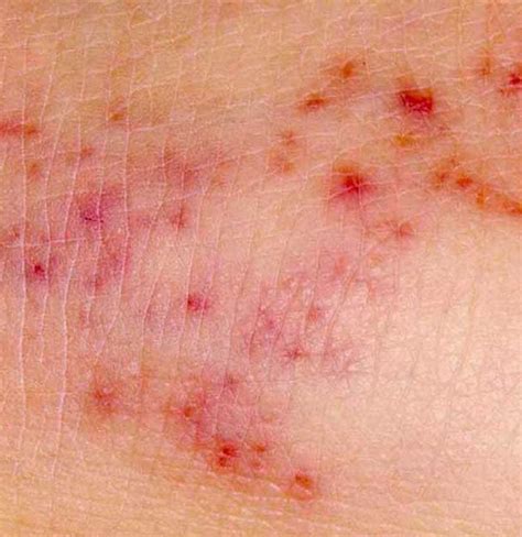 Common Skin Rashes In Adults