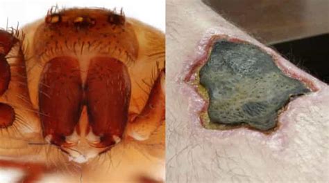 10 Gruesome Wounds Inflicted By Venomous Animals Graphic Images