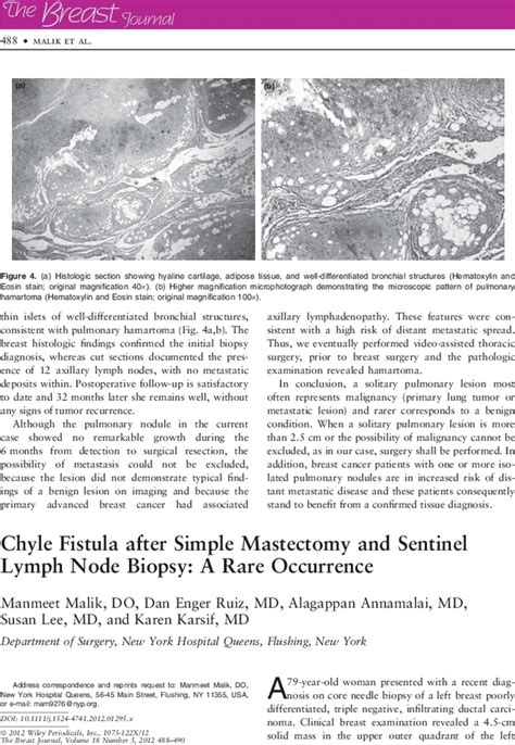 Chyle Fistula After Simple Mastectomy And Sentinel Lymph Node Biopsy A