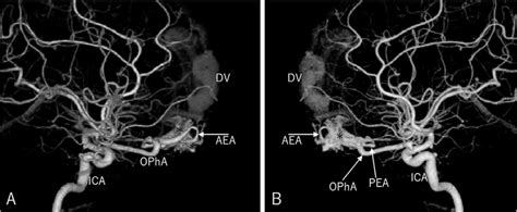 Preoperative Right A And Left B Internal Carotid Angiography