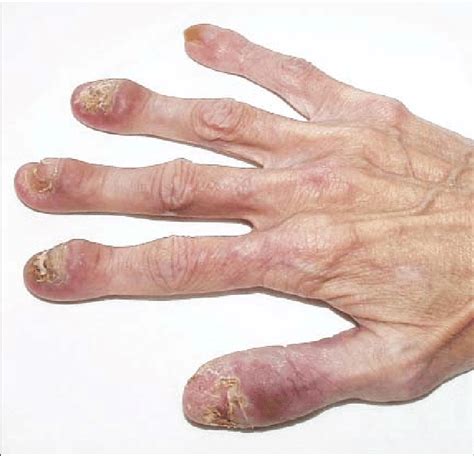 Obr Chronic Mucocutaneous Candidiasis Severe Chronic Mycosis Of