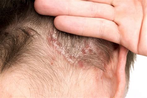 Mild Psoriasis Images Galleries With A Bite