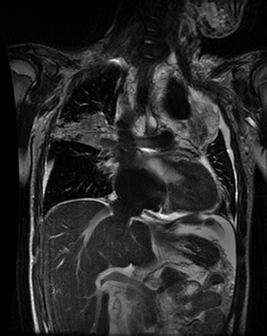 Postmortem MR Imaging In The Fetal And Neonatal Period Radiology Key