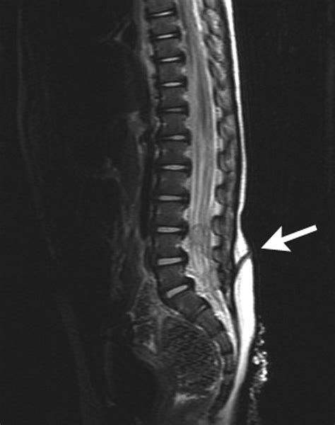 Recurrent Meningitis In A Child Due To An Occult Spinal Lesion Cmaj