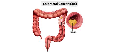 Colorectal Cancer Types Causes Symptoms Prevention Treatment