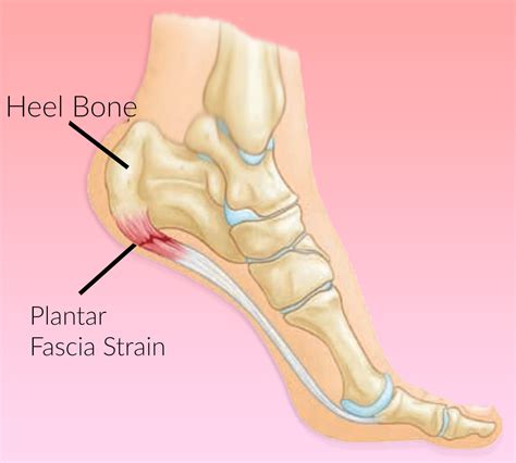Foot Anatomy Plantar Fasciitis