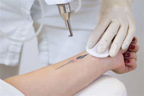 Remoci N L Ser De Tatuajes Prana Clinic
