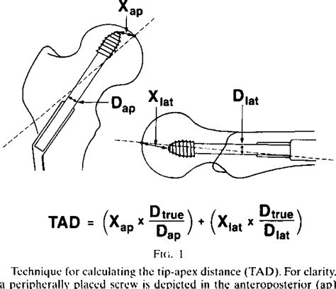 The Value Of The Tip Apex Distance In Predicting Failure Of Fixation Of