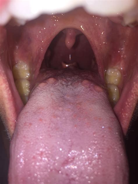 What Is This Sticking Up Behind My Tongue Medical
