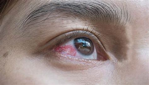 Popped Blood Vessel In Eye Can Warn Of Strokes