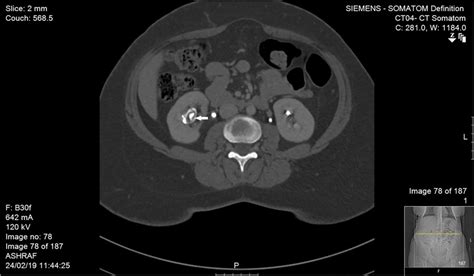 Enhanced Axial A Ct Scan Of The Abdomen At The Level Of The Kidneys