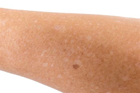 White Spots On Skin Treatment And Vitiligo Causes And Vitiligo Symptoms