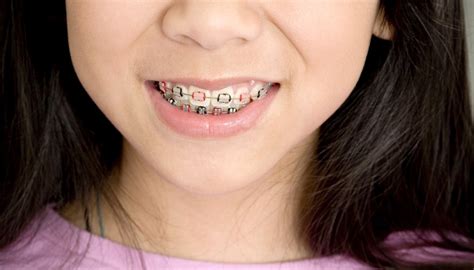 How to get braces for free or an affordable price. How to Get Free Braces in Los Angeles | Pocket Sense