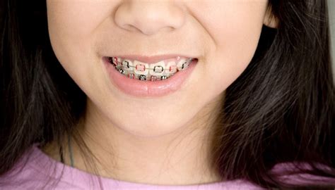 Online, article, story, explanation, suggestion, youtube. How to Get Free Braces in Los Angeles | Pocket Sense