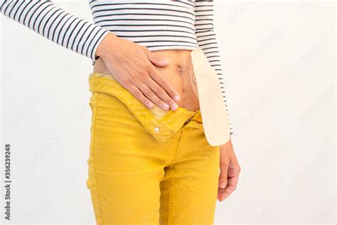 Colostomy Bag On Person Picture From Side Stock Photo Adobe Stock