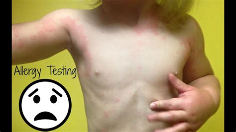 Toddler Allergy Testing Youtube
