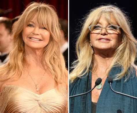 Goldie Hawn Before And After Plastic Surgery 02 Celebrity Plastic Surgery Online