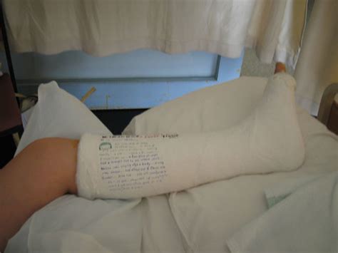 My Sisters Plaster Cast On Her Broken Leg Yylee98 Flickr