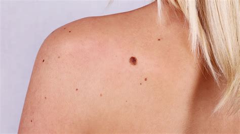 Majority Of Melanoma Skin Cancer Patients Do Not Have Irregular Moles