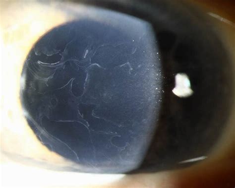 About Map Dot Fingerprint Dystrophy — Moyes Eye Center