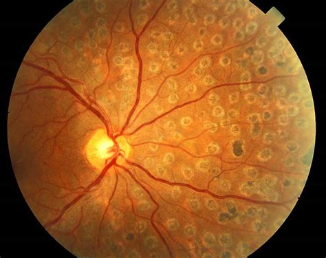 Retinal Laser Therapy Retina Laser Treatments For Diabetes