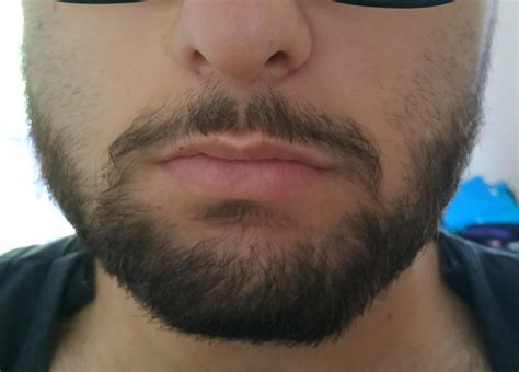 Guys I M 19 And I Have A Beard Structure Like This I Want My Mustache