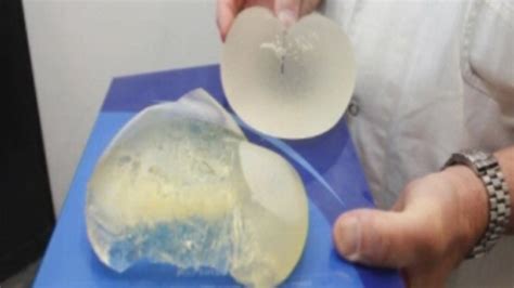 Breast Implants Welsh Nhs To Replace Privately Fitted Pip Implants