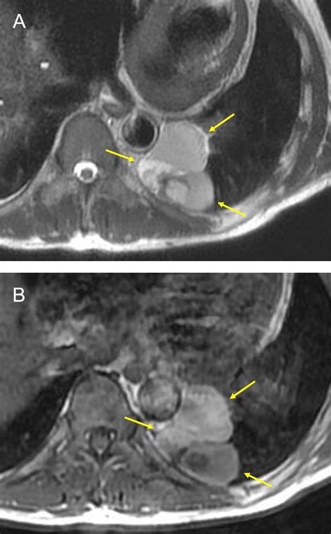 Mri Of The Pancreas A T2 Weighted Image In The Axial Plane Show A