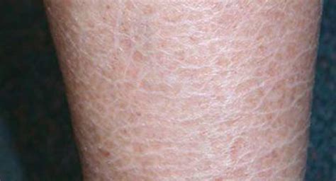 Ichthyosis Vulgaris Causes Symptoms And Diagnosis