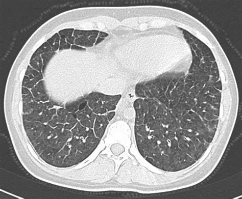 Pulmonary Veno Occlusive Disease Misdiagnosed As Idiopathic Pulmonary