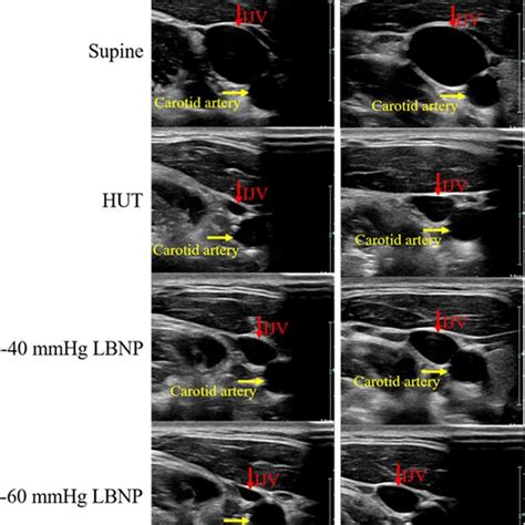Internal Jugular Vein Ijv Imaging By B‐mode Ultrasonography Right