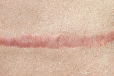 Botulinum Toxin Type A Effective For Treatment Of Hypertrophic Scars