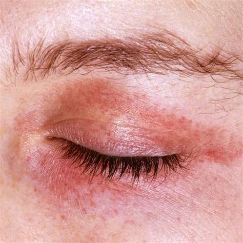 Skin Diseases 15 Uncommon Skin Conditions