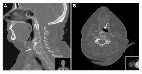 Oropharyngeal Dysphagia As An Uncommon Manifestation Of An