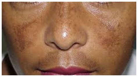Cheap face foundation, buy quality beauty & health directly from china suppliers:melasma hyperpigmentation cream skin whitening dark spots rosacea acne spots peeling skin the only effective cream for melasma, hyperpigmentation, dark spots, age spots. How to cure Hyper Pigmentation // Best and Genuine Cream ...