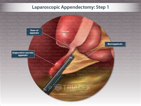 Laparoscopic Appendectomy Procedure