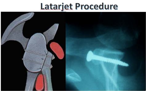 Boston Shoulder Institute Latarjet Procedure