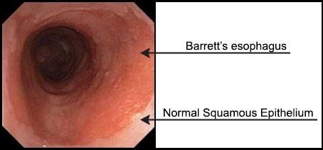 We call this feeling dysphagia, also known as difficulty with swallowing. How come when I eat solid foods once it gets through my ...