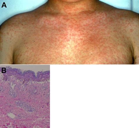 A Diffuse Erythematous Maculopapular Rash In The Acute Stage B