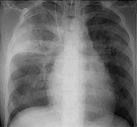 Frontal Chest Radiograph Shows A Large Area Of Right Upper Lobe