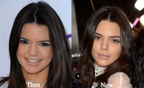 Kendall Jenner Plastic Surgery Lip Fillers Before And After Photos Latest Plastic Surgery