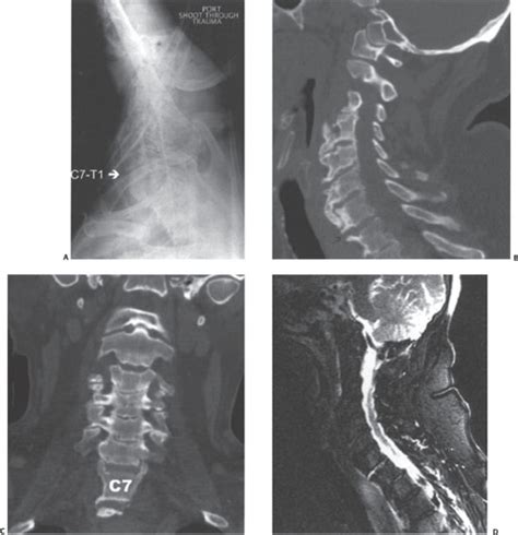 Cervical Fractures In Diffuse Idiopathic Skeletal Hyperostosis Neupsy Key