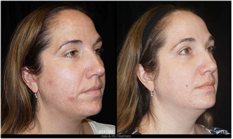 Intense Pulsed Light Sacramento Skin Discoloration Treatment Davis