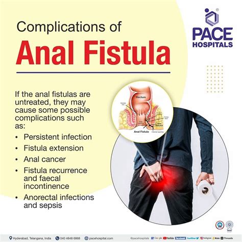 Anal Fistula Symptoms Causes Types Complications Prevention