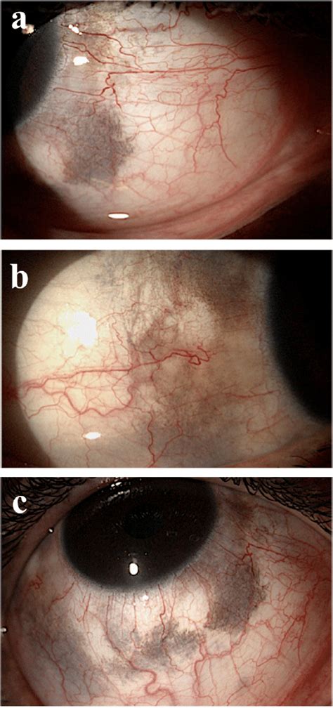 Scleral Pigmentation Was Most Noticeable In The Nasal 2a And Temporal