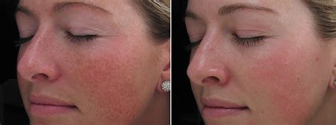 What Is An Ipl Photofacial And What Can It Do For My Face