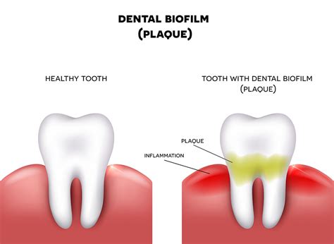 Fighting Biofilms Dentalplans Blog
