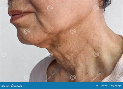 Aging Skin Folds Or Skin Creases Or Wrinkles At Neck Stock Image